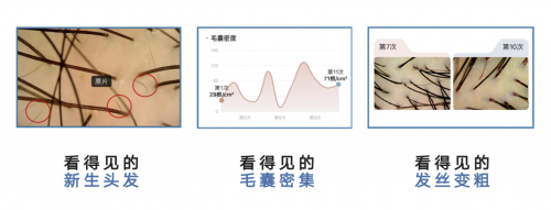Get超院线级防脱养发实力看得见效果的MYAI密发仪(图8)